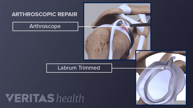 Illustration showing anatomy of shoulder joint anthroscope and another inset showing trimmed labrium.