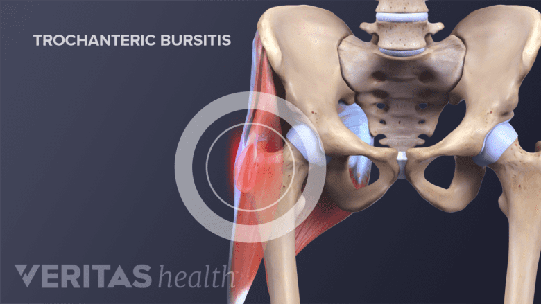 Anterior view of a trochanteric bursitis in the hip joint