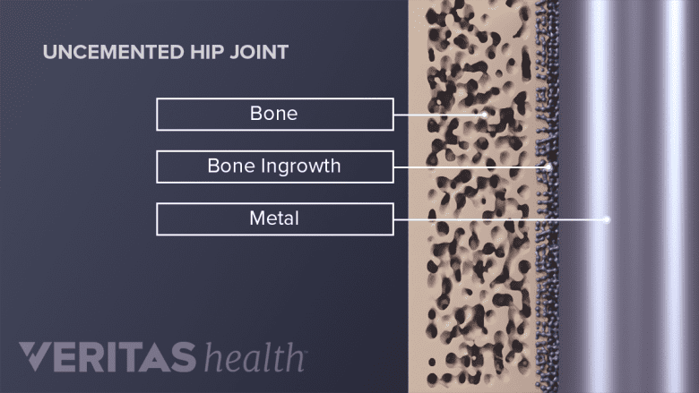 Bone growing into the uncemented metal of a hip implant.