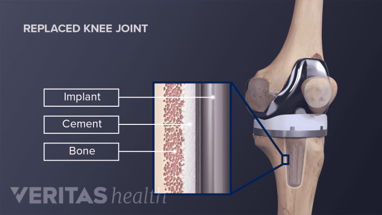 Illustration of uncemented knee arthroplasty