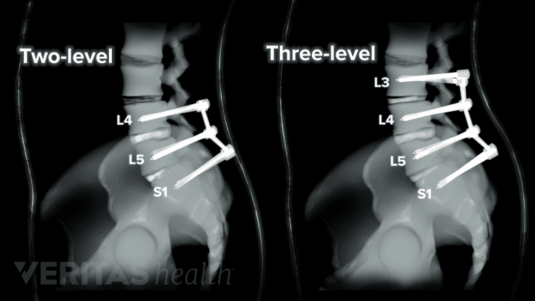 Illustration showing x-ray of lower spine with multilevel fusion.