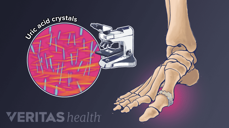 Formation of gout crystals from uric acid.
