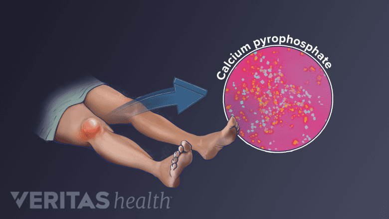 Pseudogout crystals in the knee.