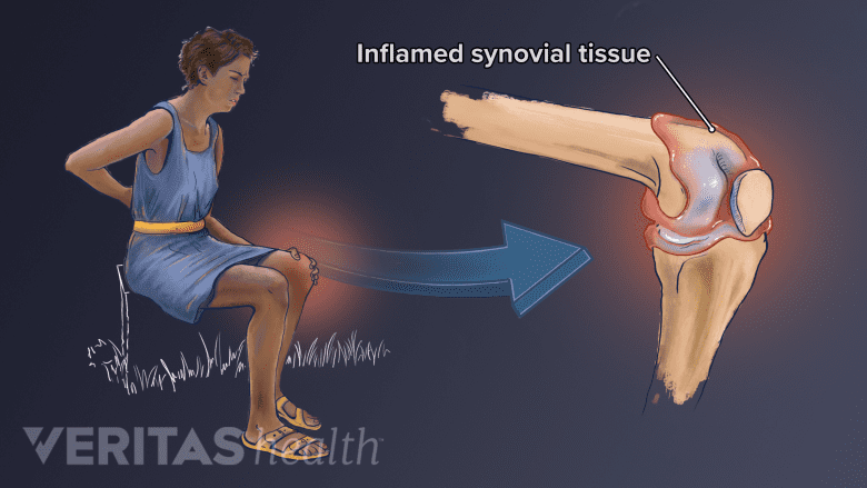 Illustration of inflamed synovial tissue in the knee cause by psoriatic arthritis