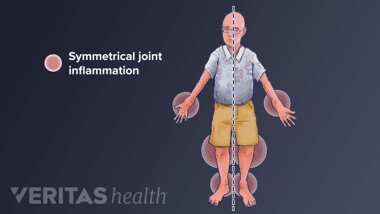 Illustration of symmetrical joint pain from rheumatoid arthritis