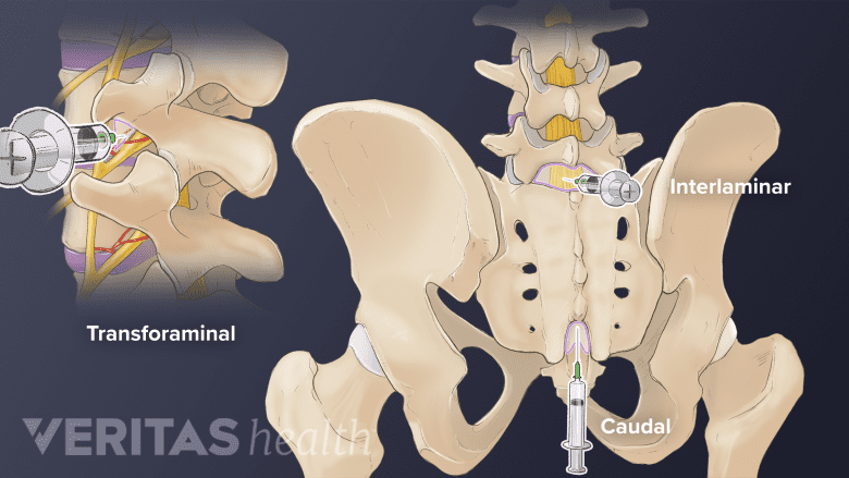 vitamin b12 injection for sciatica Injection: Uses, How to Take It & Side Effects Vitamin B12 Injection - 10mL