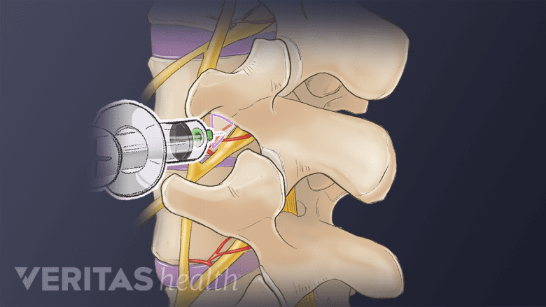 An illustration showing a adult spine with needle inserted into it.