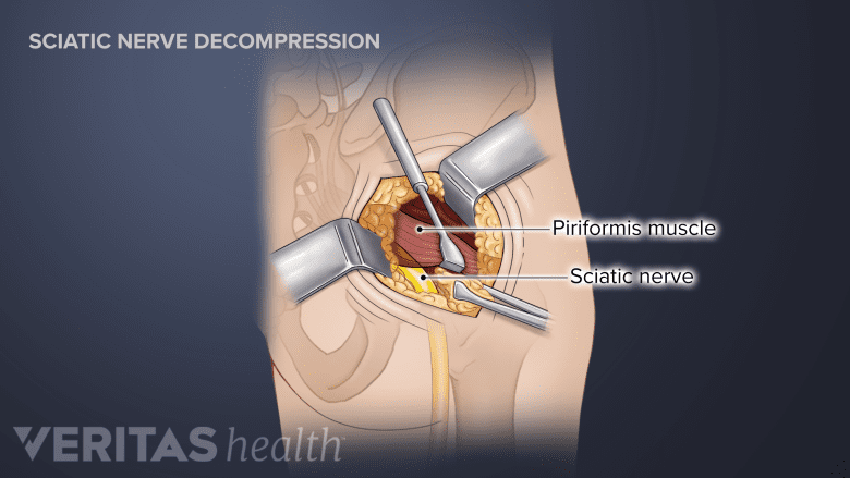lidocaine b12 injections for piriformis syndrome Injection: 7 Proven Steps to Lasting Relief Today Piriformis Injection | Piriformis Syndrome