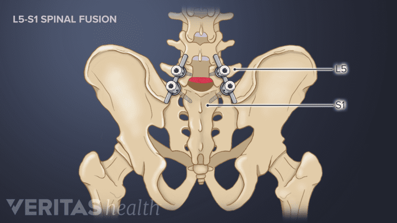 Lumbar spinal fusion at L5-S1.