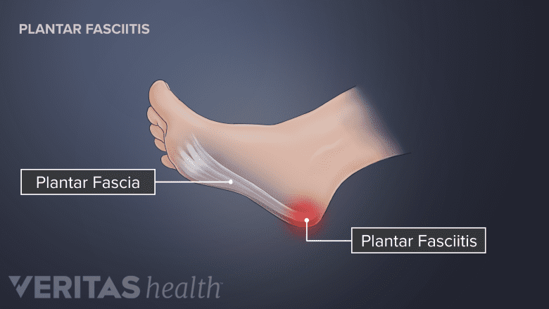 Side view of the foot labeling the plantar fascia and planter fasciitis pain.