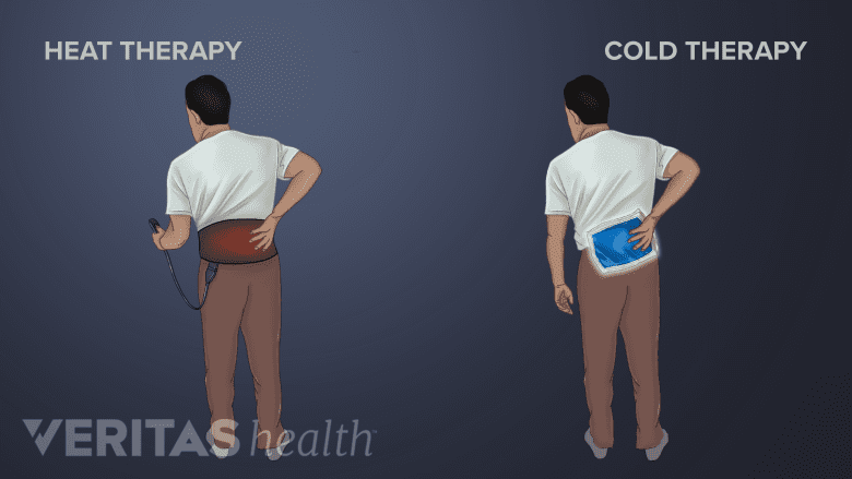 Illustration showing heat and cold therapy.