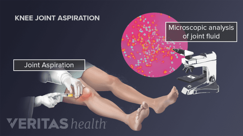 Illustration showing Joint aspiration done on a person.