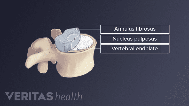 Illustration of a cervical vertebra showing the bone, disc, and endplate.