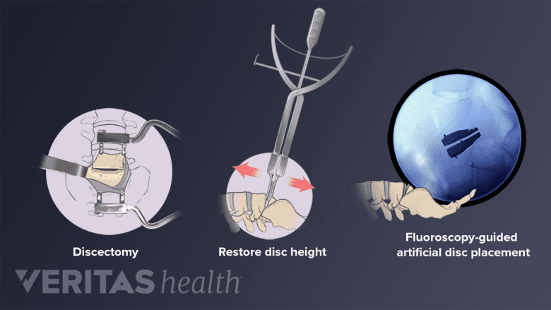 Total disc replacement procedure steps