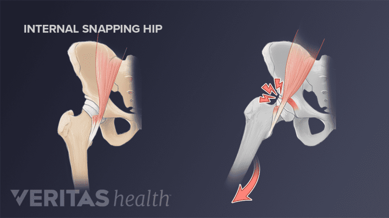 Side-by-side illustration of an internal snapping hip