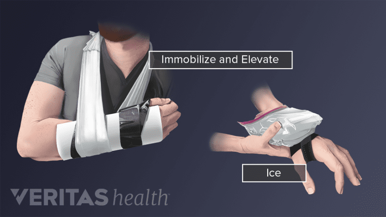 Wrist in a sling to immobilize and elevate and someone icing wrist with a brace