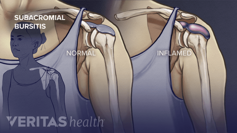 Anterior view of a normal shoulder joint and a joint with a bursa.