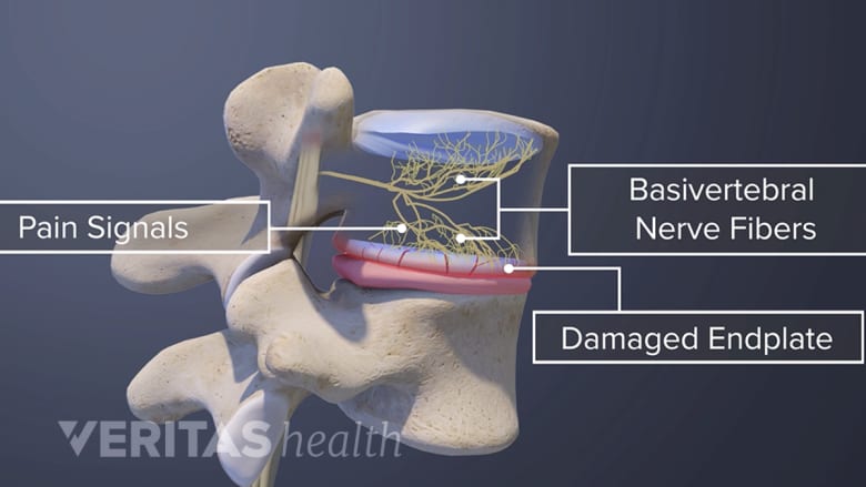 Vertebrogenenic Pain and Endplates
