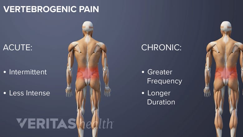 vertebrogenic chronic versue acute pain