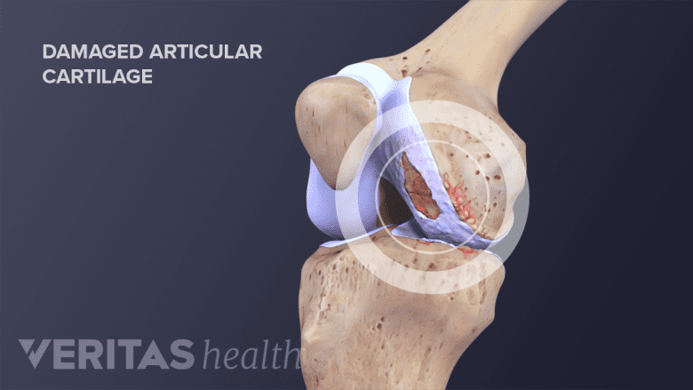 Damaged articular cartilage.
