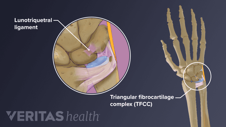 lunotriquetral ligament and triangular fibrocartilage complex (TFCC) tears in the wrist