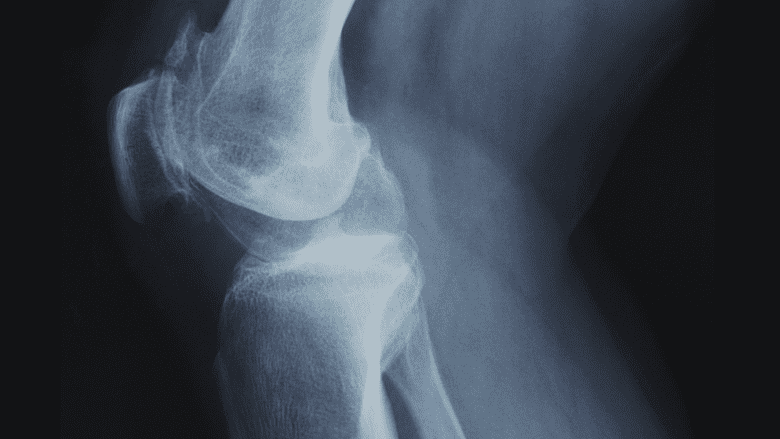 Illustration showing x-ray image of knee joint.