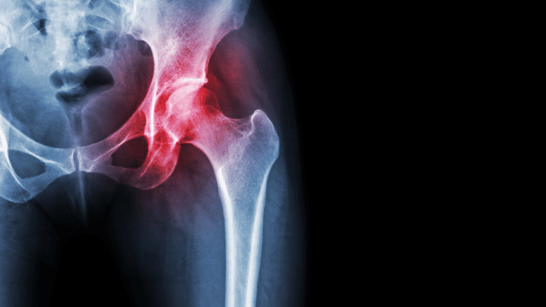 Hip X-ray showing pain.