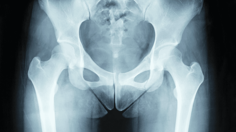 Illustration showing x-ray of pelvis.