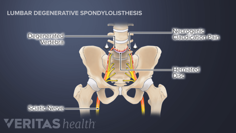 Nerve Pain In The Leg Spine health nerve-pain-in-the-leg-spine-health