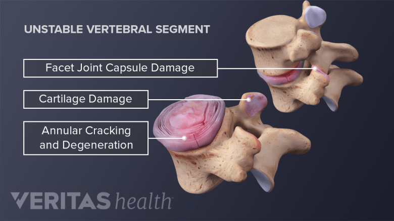 Causes of Degenerative Disc Disease Pain | Spine-health