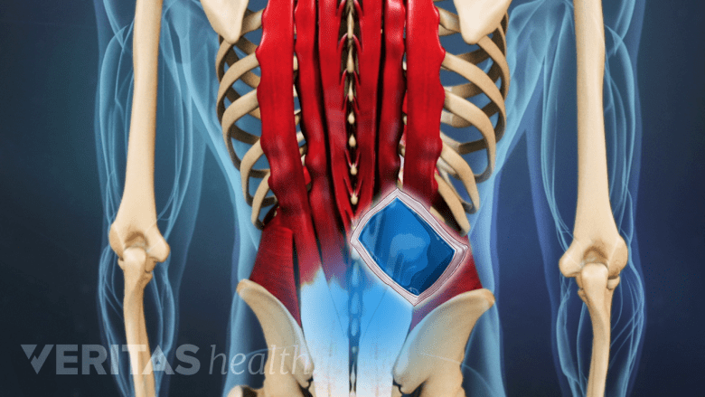 Spinal Column Rfa Radiofrequency Ablation (RFA): Procedure and Recovery | Spine-health