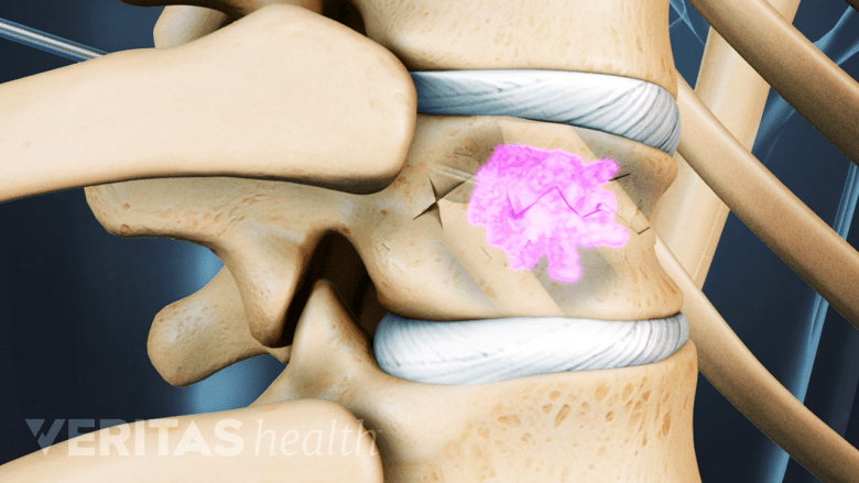 Types of Lumbar Spine Surgeries: What You Need to Know | Spine-health