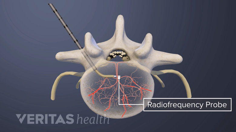 Basivertebral Nerve Ablation Explained Step-by-Step | Spine-health