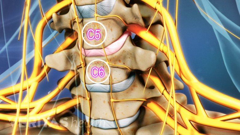 Problem C6 C5-C6 Treatment | Spine-health