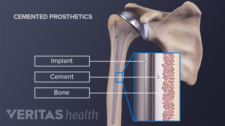 A cemented shoulder replacement joint.