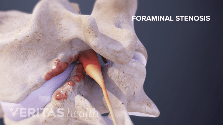 types-of-spinal-stenosis-spine-health