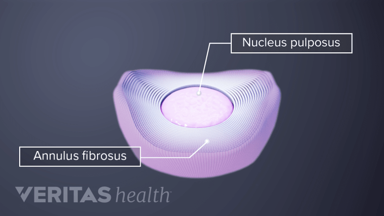 Pulpus Lumbar Discs | Spine-health