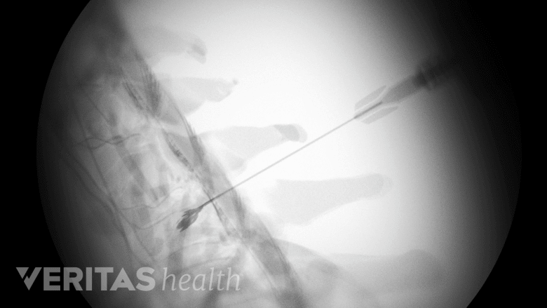 Selective Nerve Root Block Injections | Spine-health