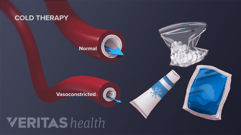 Cold and Heat Therapy for Sciatica | Spine-health