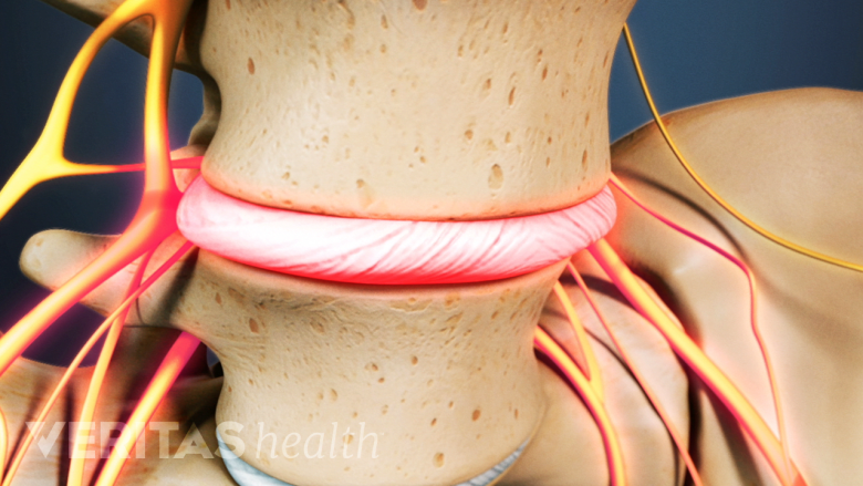 Lumbar Epidural Steroid Injections for Low Back Pain and Sciatica ...