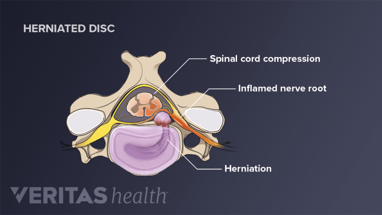 Cervical Disc Explination Cervical Radiculopathy from a Herniated Cervical Disc | Spine-health