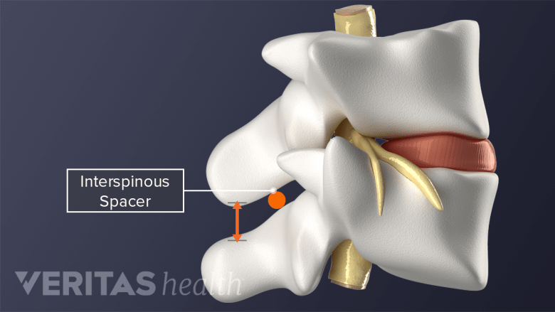 Interspinous Process Injection Spinal Stenosis Surgery | Spine-health