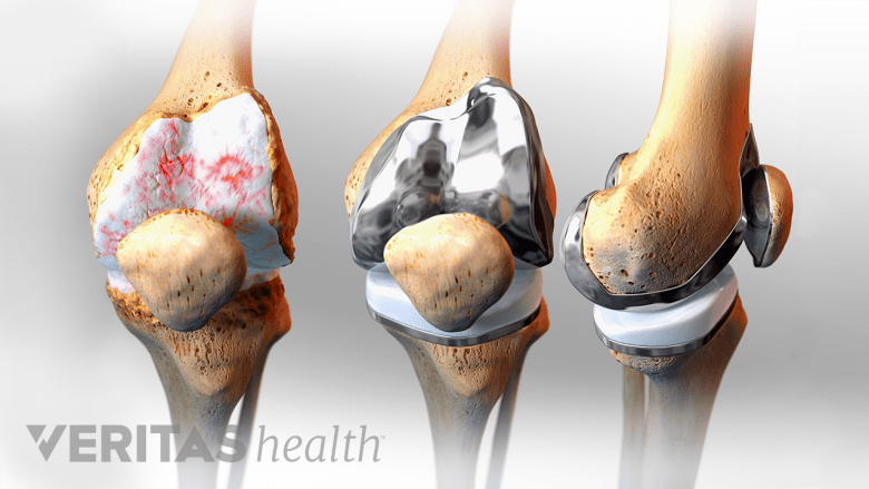 When to Consider Knee Replacement Surgery | Arthritis-health