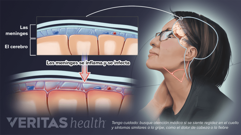 Una mujer con meningitis.