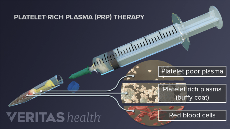 Platelet Rich Plasma Injection Procedure Arthritis health platelet-rich-plasma-injection-procedure-arthritis-health