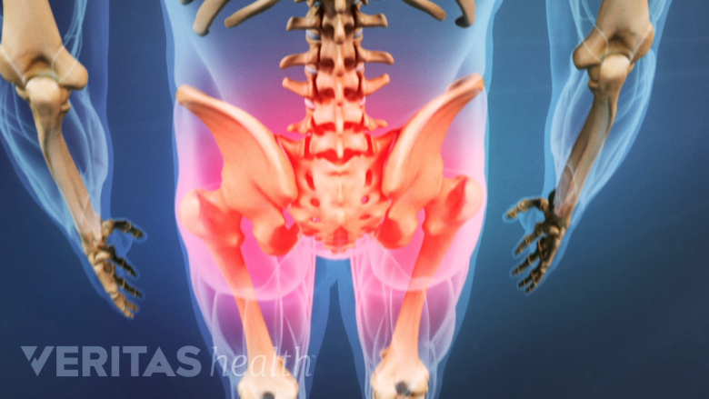 Symptoms of Chronic High (Proximal) Hamstring Tendinopathy | Sports-health