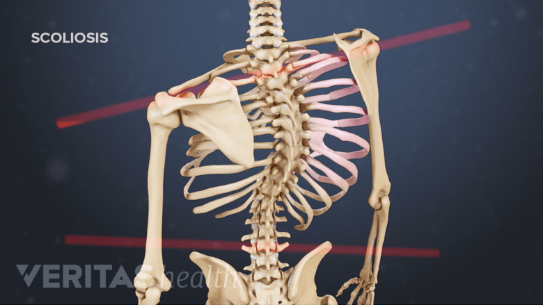 Scoliosis: What You Need to Know | Spine-health