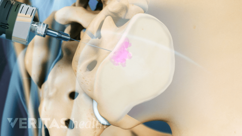 Sacroiliac Joint Injections: Risks, Success Rates, and Long-Term ...