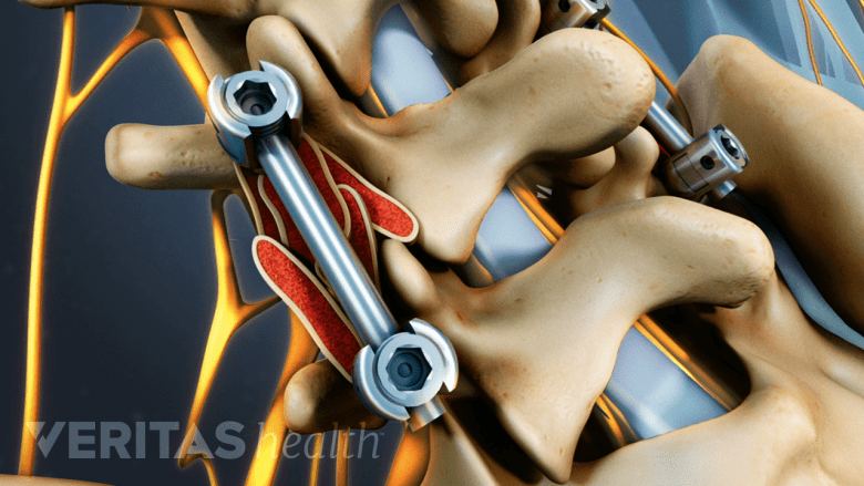 Bone Fusion Process The Multilevel Spinal Fusion Surgery | Spine-health