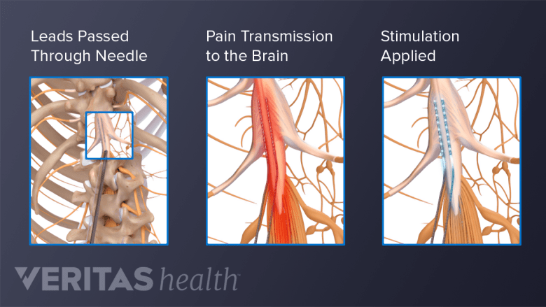 Scs Waveforms Recovery After Spinal Cord Stimulation Trial | Spine-health